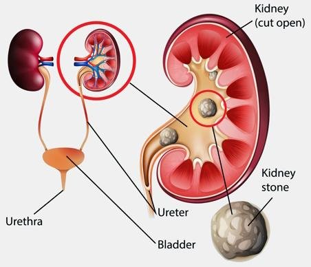 Cirurgia de cálculo renal em Manaus: tratamento especializado para eliminar pedras nos rins e no trato urinário
