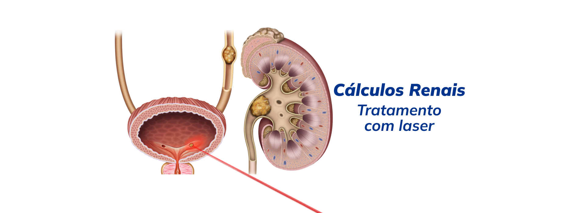 Banner Banner cálculos renais