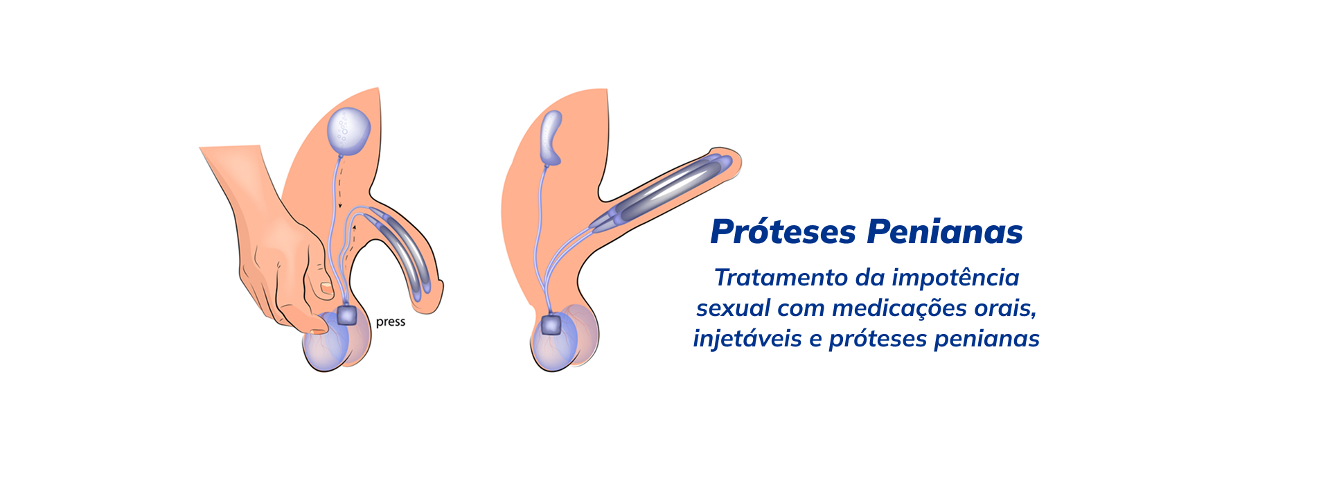 Banner Banner proteses penianas