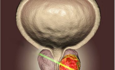 Cirurgia HoLEP em Manaus: veja quando esta técnica pode ser a melhor opção para tratar a próstata aumentada