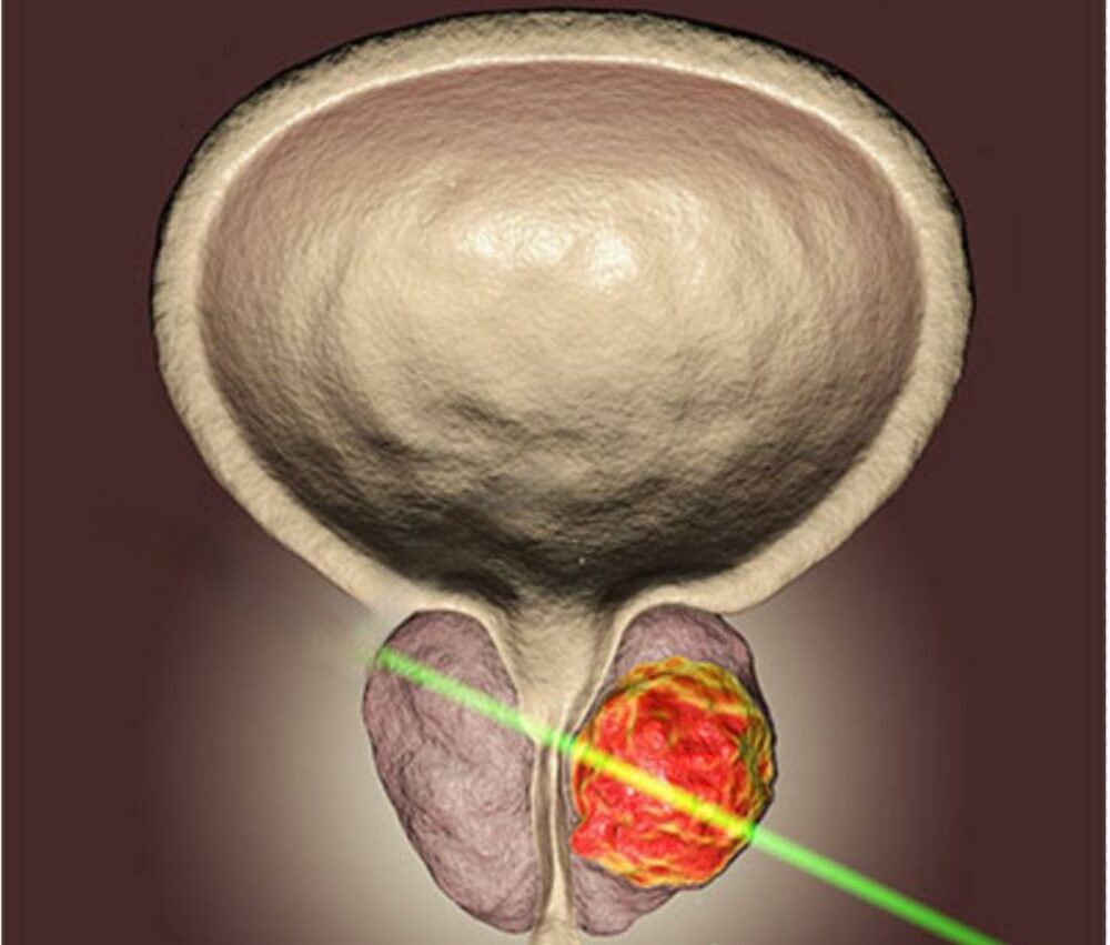 Cirurgia Holep em Manaus com especialista e atendimento exclusivo