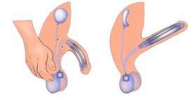Garanta confiança e suporte familiar ao optar pela cirurgia de prótese peniana em Manaus