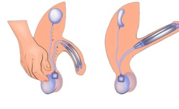 Garanta confiança e suporte familiar ao optar pela cirurgia de prótese peniana em Manaus
