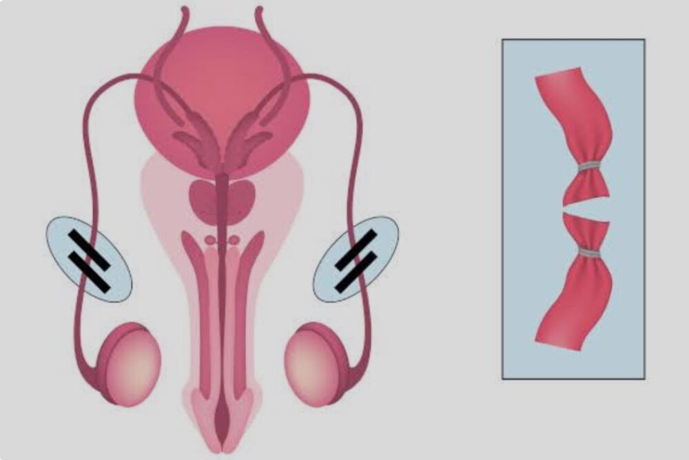 Realize sua vasectomia com tecnologia avançada e atendimento humanizado em Manaus