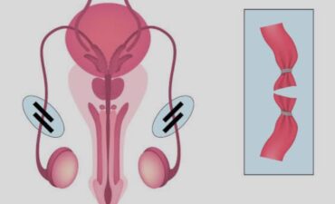 Realize sua vasectomia com tecnologia avançada e atendimento humanizado em Manaus